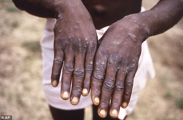 84968531-13743701-Telltale_signs_of_mpox_are_skin_rashes_and_lesions_Muscle_aches_-a-1_1723656677597.jpg