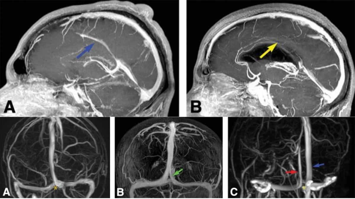 dural-venous-sinuses.jpg